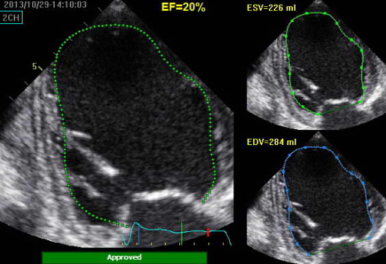 Cardiac ultrasound Auto-EF