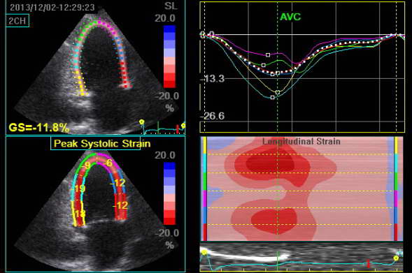 Cardiac ultrasound AFI